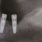 Dr Orr bad angle of implant