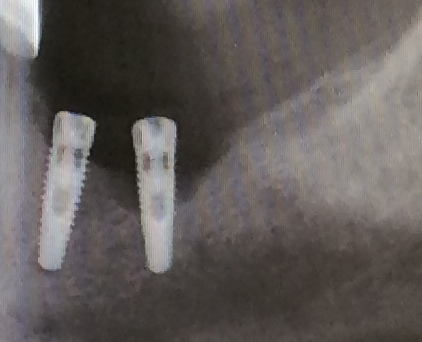 Dr Orr bad angle of implant